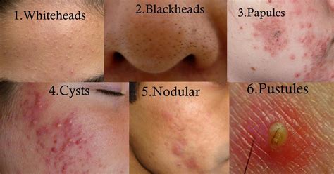 Close-up image showing inflamed acne lesions like papules, pustules, nodules, and cysts