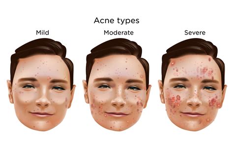 Infographic comparing mild, moderate, and severe acne classifications with lesion counts