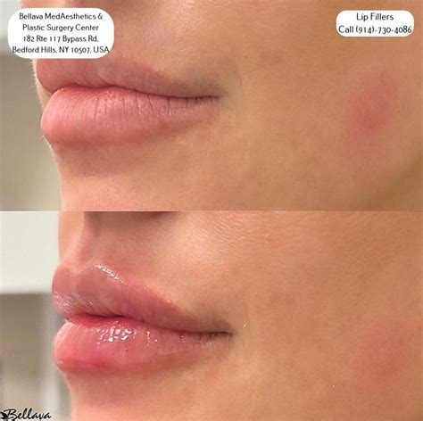 Close-up of lips immediately after filler, showing slight redness and puffiness