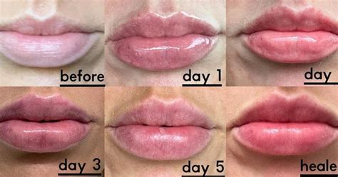 Diagram showing the typical progression of lip filler swelling over several days