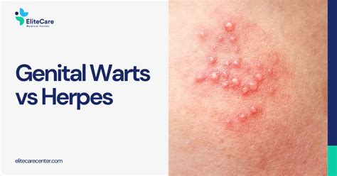 Comparison chart highlighting the key differences between eczema, herpes, and fungal infections in the genital area.