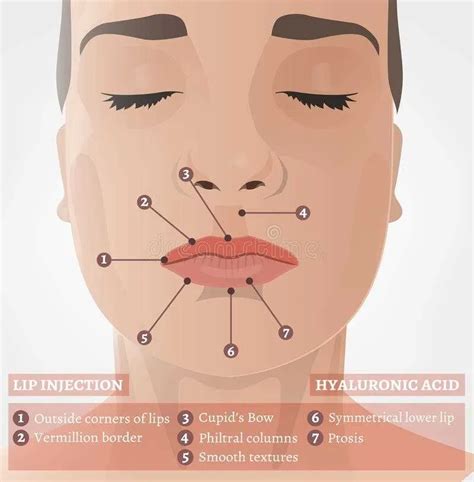 Diagram illustrating the injection points for lip fillers to achieve enhanced volume and shape.