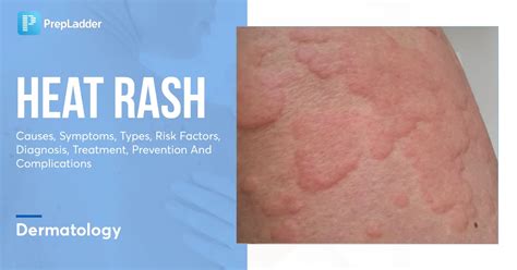 Diagram illustrating the layers of skin and how trapped sweat causes heat rash.