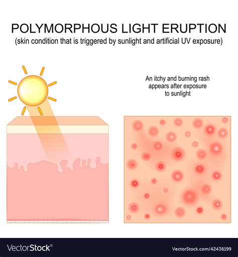 Illustrations showing different forms of polymorphous light eruption rash.