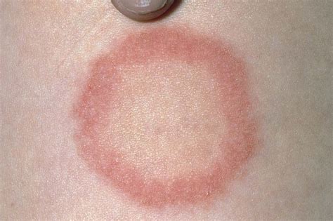 Diagram illustrating the ring-shaped rash characteristic of ringworm, with a clear center and raised, red border.