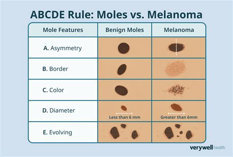 comparison chart showing the visual differences between a common mole, a benign growth, and early signs of melanoma