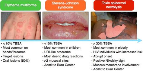 Illustration comparing the appearance of MIRM, Erythema Multiforme, and Stevens-Johnson Syndrome rashes.