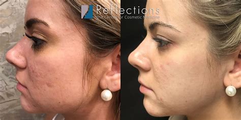 Before and after photos showcasing results of RF microneedling for acne scars and skin tightening.