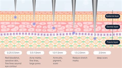 Illustration showing the depth of needle penetration in RF microneedling and the delivery of radiofrequency energy into the dermis.