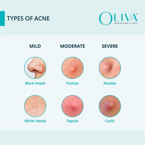 diagram comparing different acne treatment methods: topical, chemical peel, laser