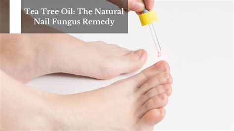 Collage of common home remedy ingredients for nail fungus: tea tree oil, Vicks VapoRub, apple cider vinegar, baking soda.