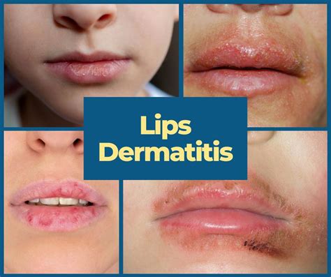 Infographic detailing the cycle of lip licking leading to dermatitis.