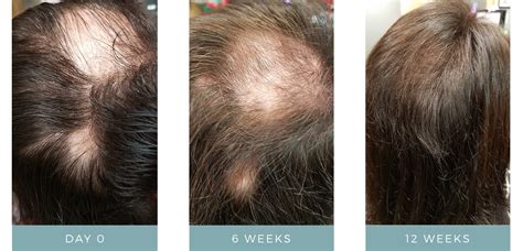 A split image showing before and after results of using a hair thickening serum, highlighting increased hair density.