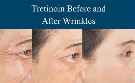 Image comparing skin before and after 6 months of consistent tretinoin use, showing reduced wrinkles and improved texture.