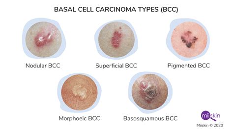 Collage of images showcasing various appearances of basal cell carcinoma.