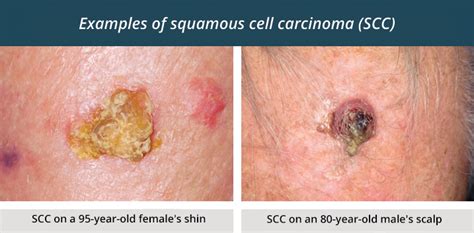 Images illustrating different presentations of squamous cell carcinoma.