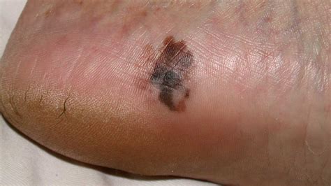Images of melanoma on the soles of the feet and under fingernails.
