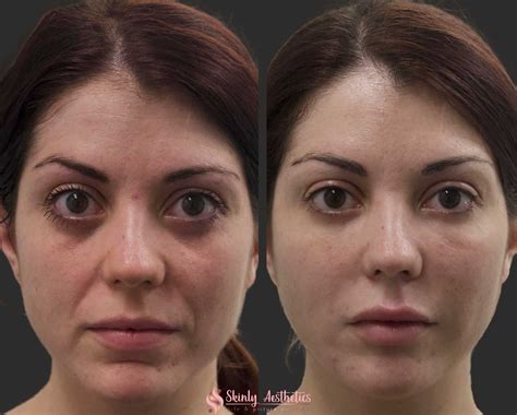 Comparison image showing under-eye area before and after consistent use of niacinamide eye cream, highlighting reduced dark circles and fine lines.