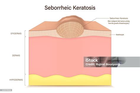 Illustration of a seborrheic keratosis growth on skin