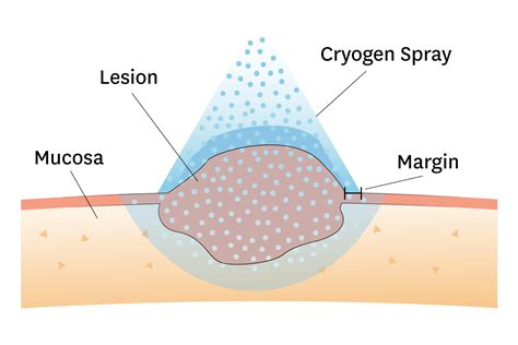 Diagram illustrating the cryotherapy process with liquid nitrogen