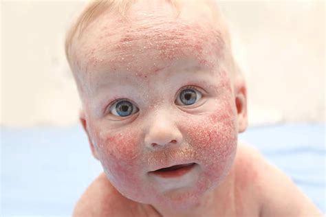 infant with eczema on face