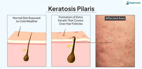 Illustration showing a hair follicle blocked by keratin buildup, causing a small bump on the skin.