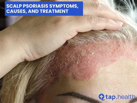 Illustration of scalp psoriasis scales and redness