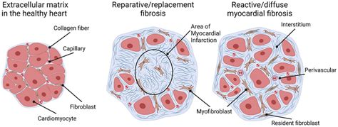 Diagram illustrating the process of fibrosis, showing the role of fibroblasts, extracellular matrix deposition, and tissue stiffening.