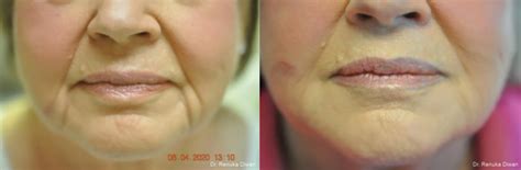 Before and after images of a patient treated for vertical lip lines, showcasing softened wrinkles and improved lip contour.