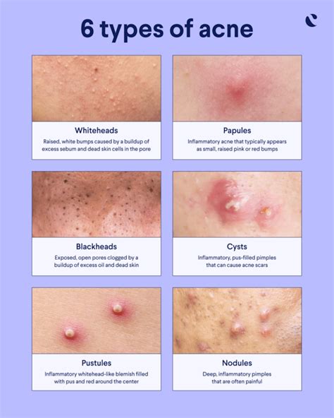 Visual comparison of different types of forehead bumps: acne papules/pustules, fungal folliculitis, boils.