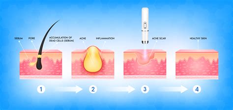 Diagram showing how pores become clogged with sebum, dead skin cells, and bacteria.