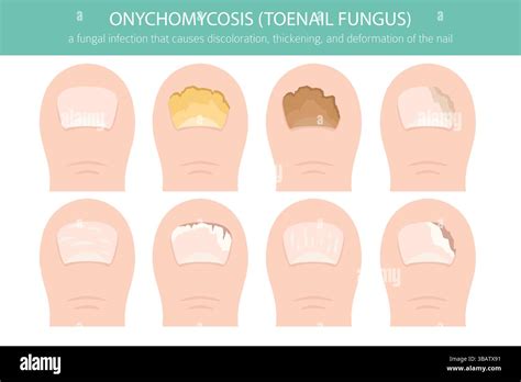 Diagram illustrating the layers of a nail and where fungal infection can occur.
