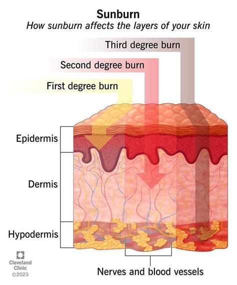 Diagram illustrating the layers of skin affected by mild, moderate, and severe sunburn.