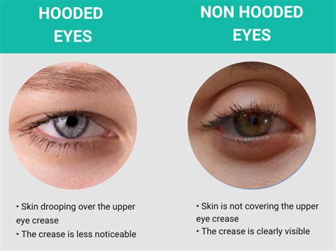 Diagram illustrating the characteristics of hooded eyes, showing the extra skin fold from the brow bone obscuring the eyelid crease.