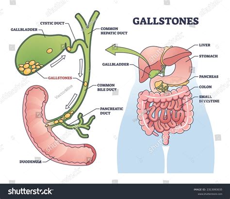 Anatomical illustration of the gallbladder and liver, highlighting their location in the upper abdomen.