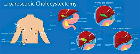 Diagram illustrating the surgical procedure for laparoscopic cholecystectomy.