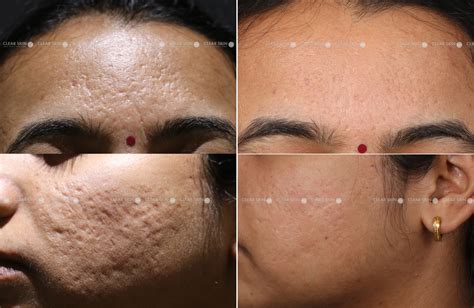 Before and after images showcasing the reduction of acne scars after fractional laser treatment.