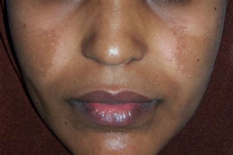 A close-up photo of a woman's upper lip showing distinct dark patches, illustrating melasma.