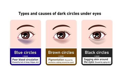 Illustration of a woman with prominent dark circles under her eyes, highlighting the eye area.
