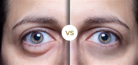 Side-by-side comparison graphic illustrating the difference between dark circles (discoloration) and under-eye bags (puffiness).