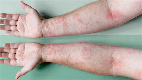 comparison chart of eczema and seasonal allergy skin symptoms