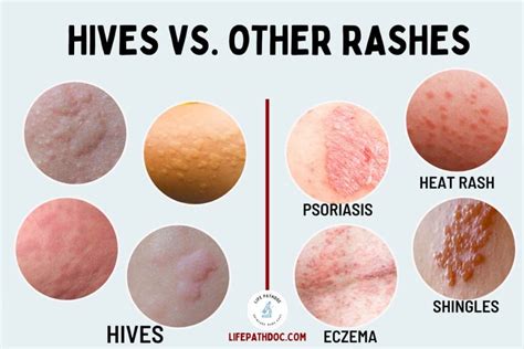 Infographic comparing histamine-driven itching (allergies, hives) with eczema-related itching, highlighting that eczema itch is often not histamine-dominant.