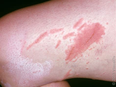 Close-up image of a poison ivy rash showing linear streaks of red bumps and blisters on the skin.