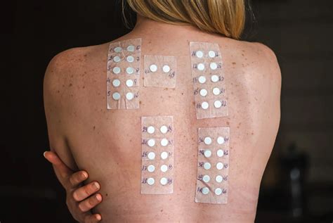 Image of a person undergoing patch testing for allergic contact dermatitis, with patches applied to their back.
