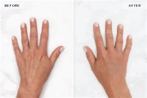 Before and after images of a patient's hands treated with Restylane Lyft, demonstrating restored volume and smoother skin.