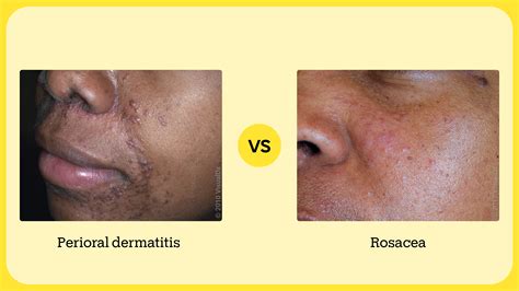 Side-by-side comparison images of perioral dermatitis, rosacea, and acne vulgaris to aid in visual differentiation.