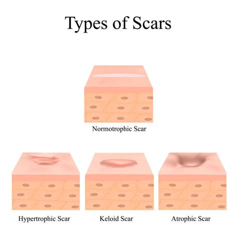 Infographic illustrating different types of scars: atrophic, hypertrophic, and discolored.