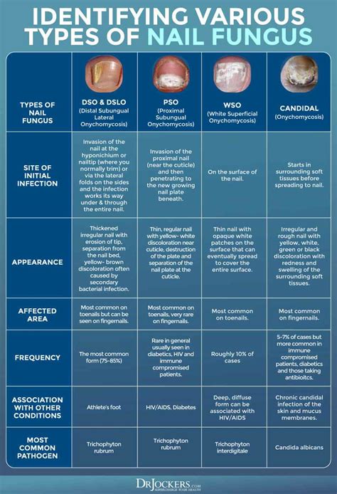 Infographic detailing the four main types of nail fungus with visual representations of their typical presentation.