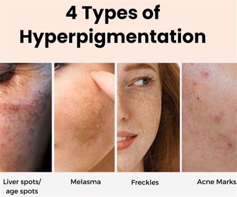 Infographic explaining different types of hyperpigmentation