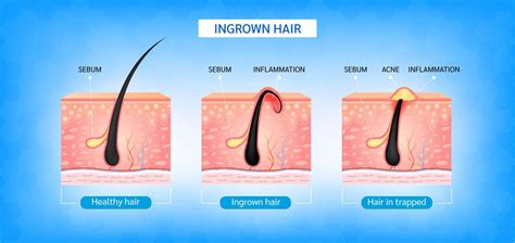Illustration showing common causes of underarm hyperpigmentation: friction, shaving, ingrown hairs, product buildup.